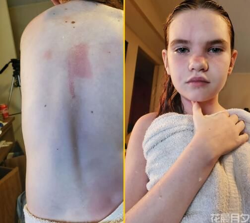 世界上对水过敏的人真存在，遇水皮肤就会起疹子