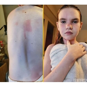 世界上对水过敏的人真存在